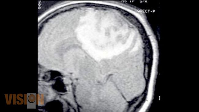 Científicos de la UMSNH compueban características neuroprotectoras de la melantonina