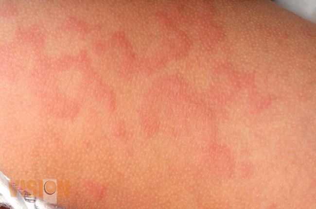 Descarta SSM supuesto brote de sarampión en la UMSNH