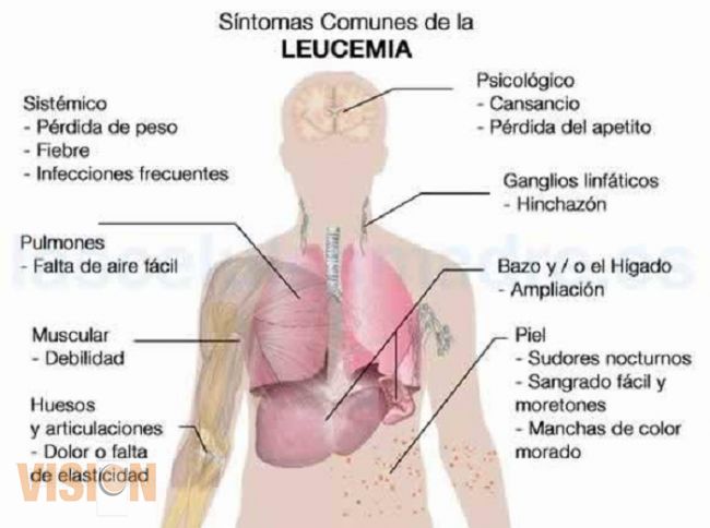 Sobreviven a la leucemia el 60% de los niños sometidos a un transplante de médula 