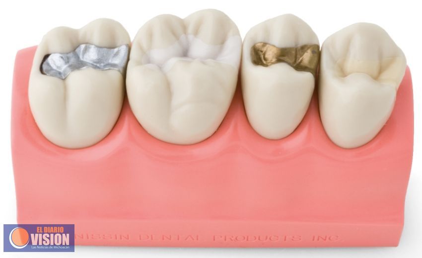 Padece caries más de 85 por ciento de los mexicanos 