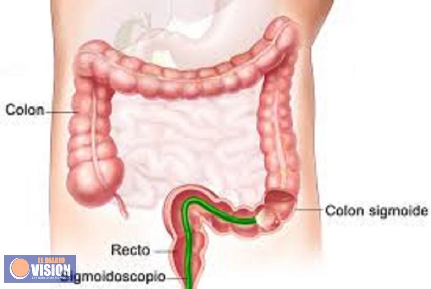 Cáncer de colon se puede prevenir