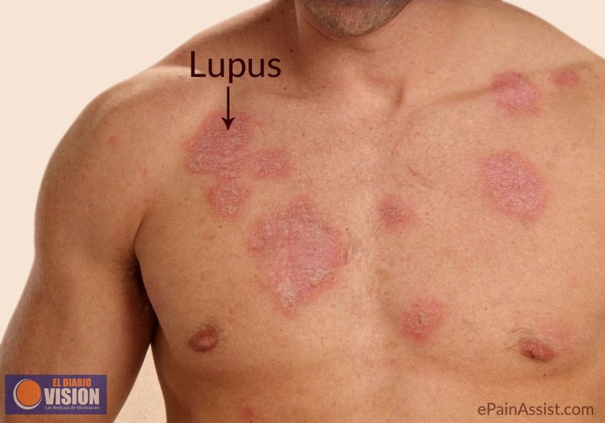 Brinda SSM atención de calidad a pacientes con lupus