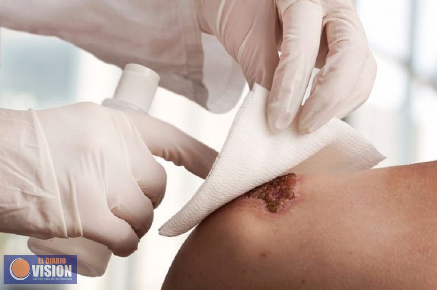 Cuenta SSM cuenta con 11 clínicas especializadas en heridas crónicas y agudas