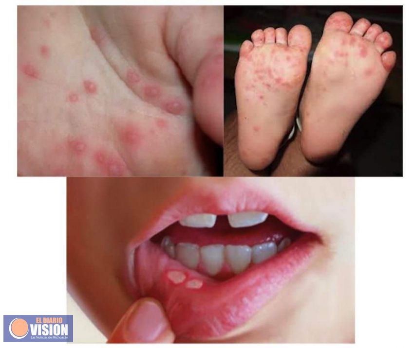 En Michoacán no hay alerta epidemiológica por virus coxsackie